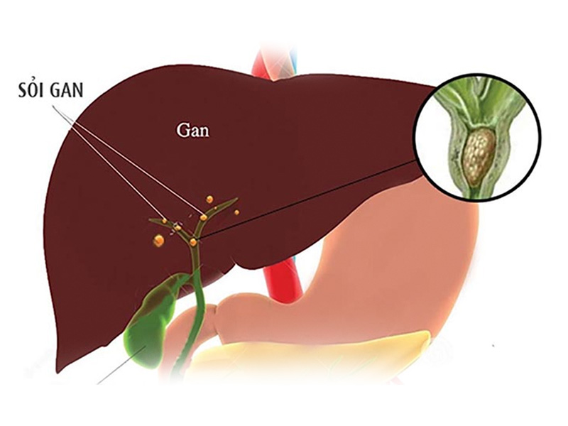 Bệnh sỏi đang ở mức báo động cao cần điều trị sớm