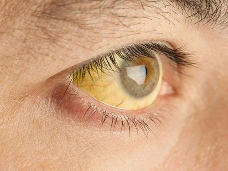 Vàng da dưới mắt là một trong những biểu hiện giúp sỏi mật phát hiện sớm
