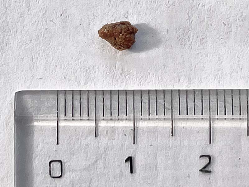 Sỏi có kích thước nhỏ dưới 5mm chưa có các biểu hiện đau viêm uống nước lọc giúp tan sỏi thận 