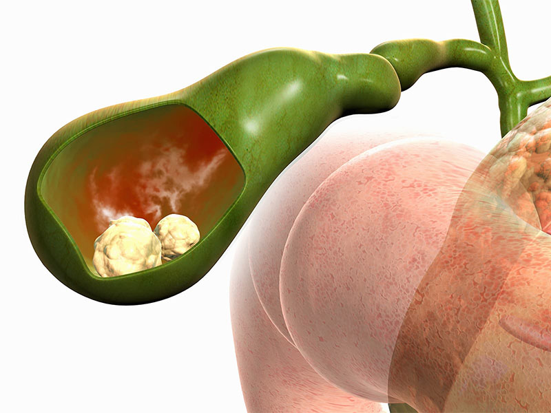 Sỏi mật là nguyên nhân chính làm cho túi mật bị viêm 