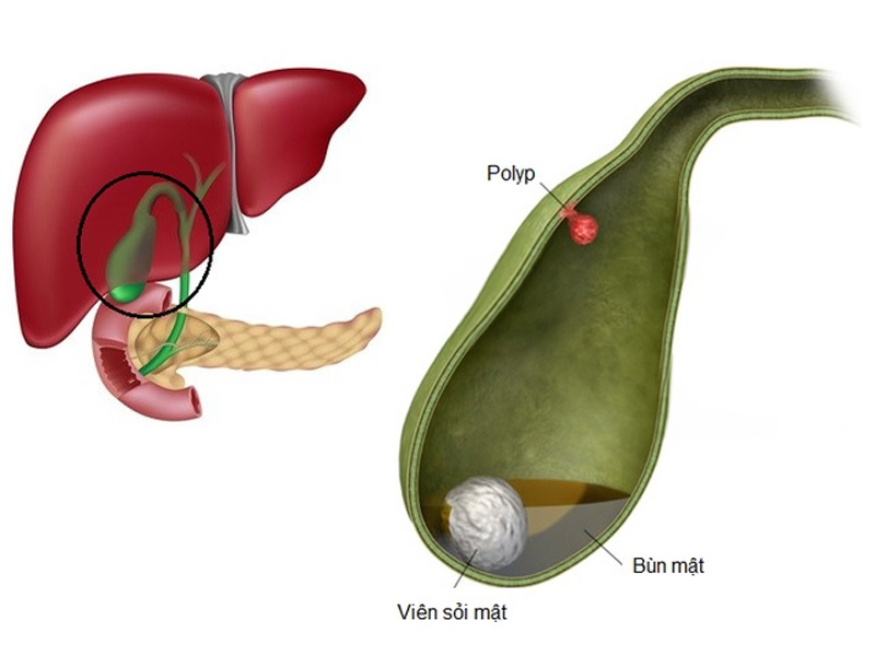 Polyp túi mật là khối u hoặc giả u lành tính xuất hiện trên bề mặt của thành túi mật