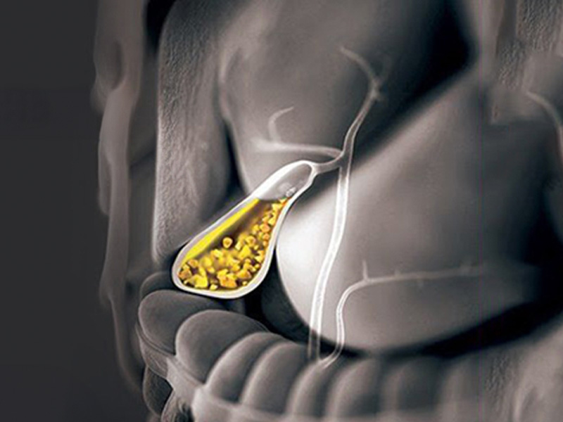 Sỏi bùn túi mật chủ yếu là dạng cholesterol và canxi bilirubinat