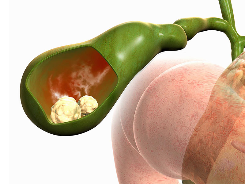 Bùn mật rất dễ hình thành nên sỏi túi mật 