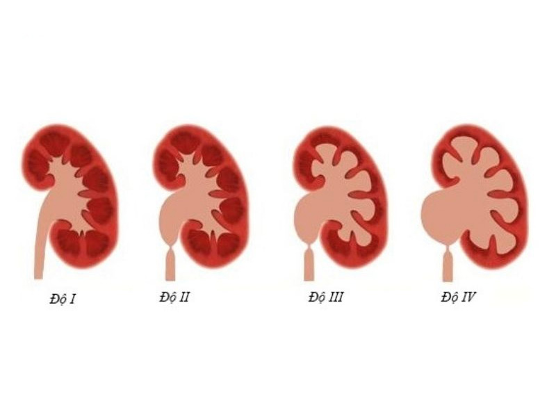 Sỏi thận 6mm có nguy hiểm không?