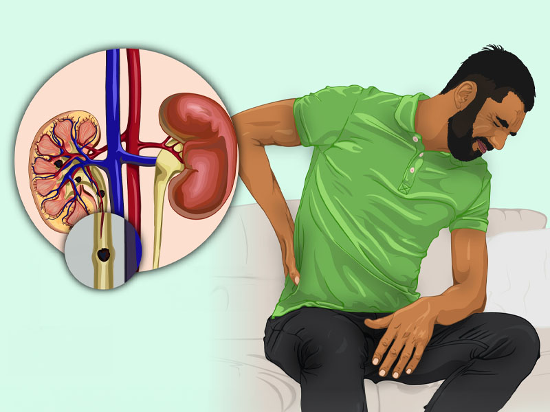 Sạn thận là gì?