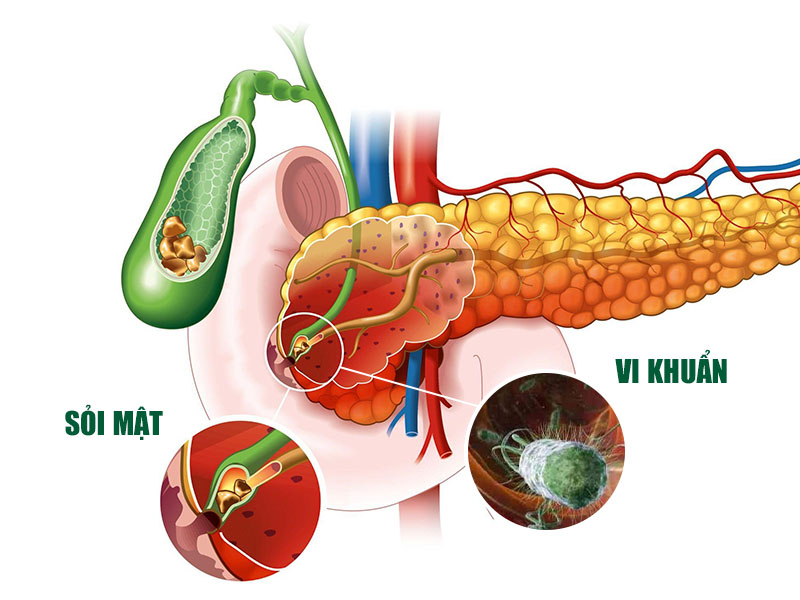 Nhiễm trùng đường mật là tình trạng đường mật bị viêm do sỏi hoặc do vi khuẩn