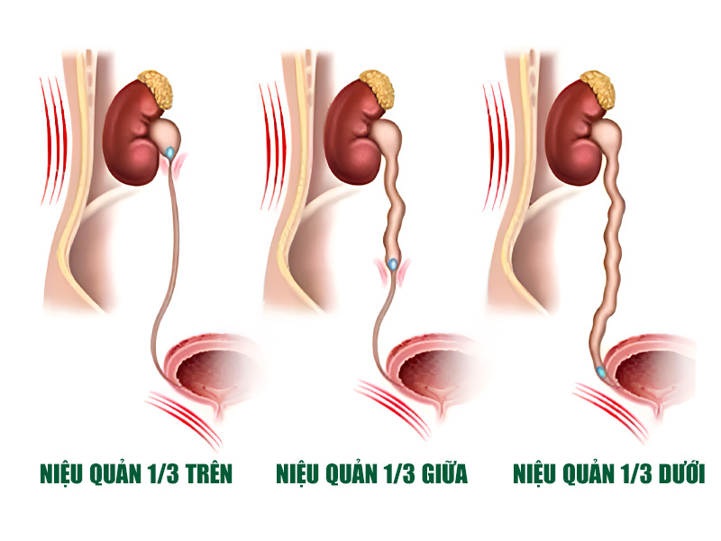  Vị trí sỏi kẹt tại 3 đoạn trong niệu quản