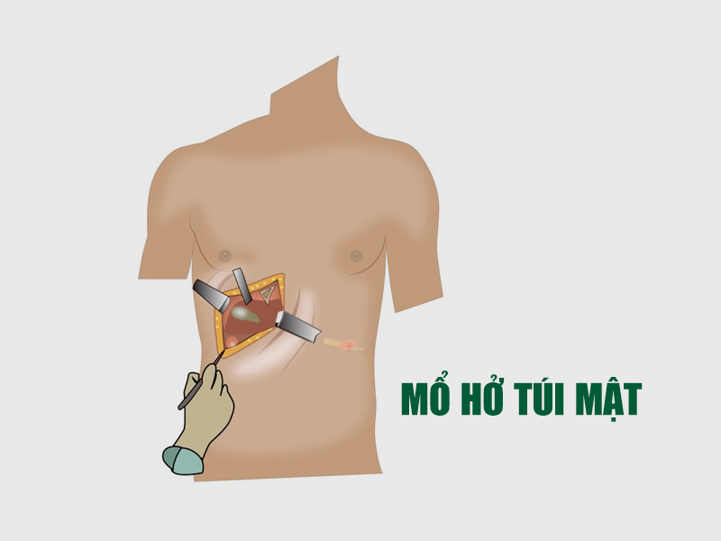 Túi mật viêm cấp tính thì mổ hở túi mật à ưu tiên hàng đầu