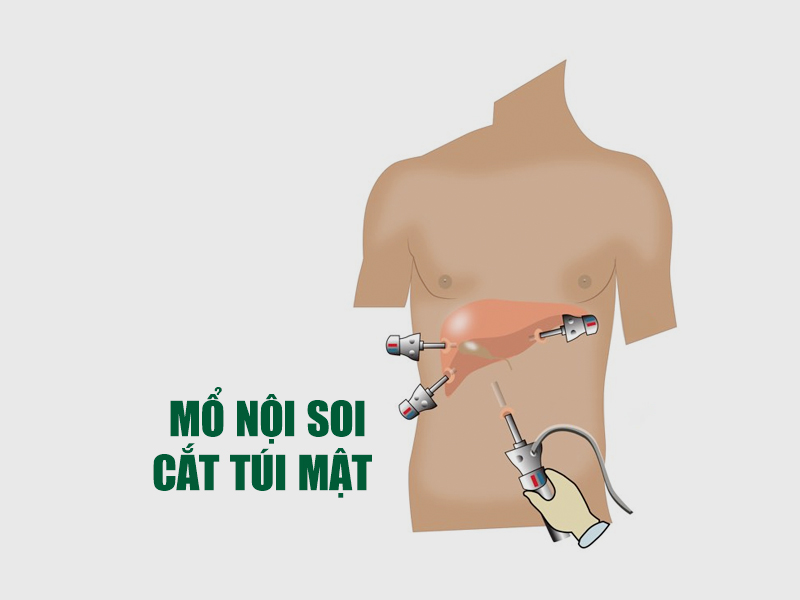 Mổ nội soi cắt túi mật gây xuất huyết bên trong 