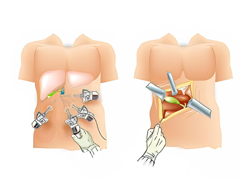 Cắt túi mật là gì?