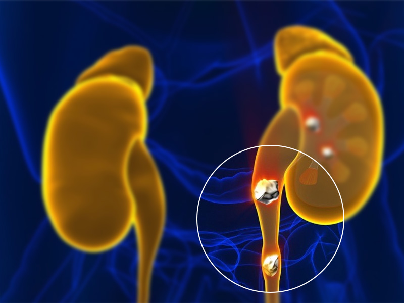 Vì sao phải điều trị sỏi niệu quản sớm?