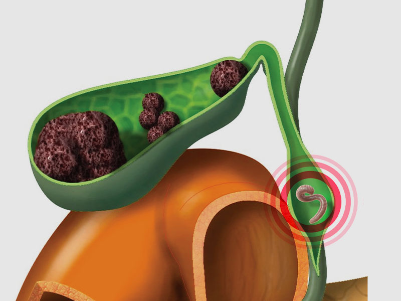 Ăn chín, uống sôi hạn chế giun sán, đào thải sỏi mật