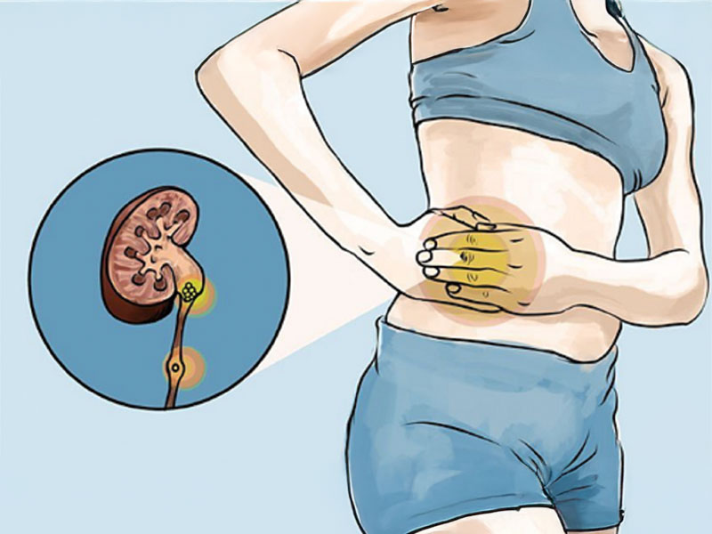  Dấu hiệu bị sỏi thận ở phụ nữ 