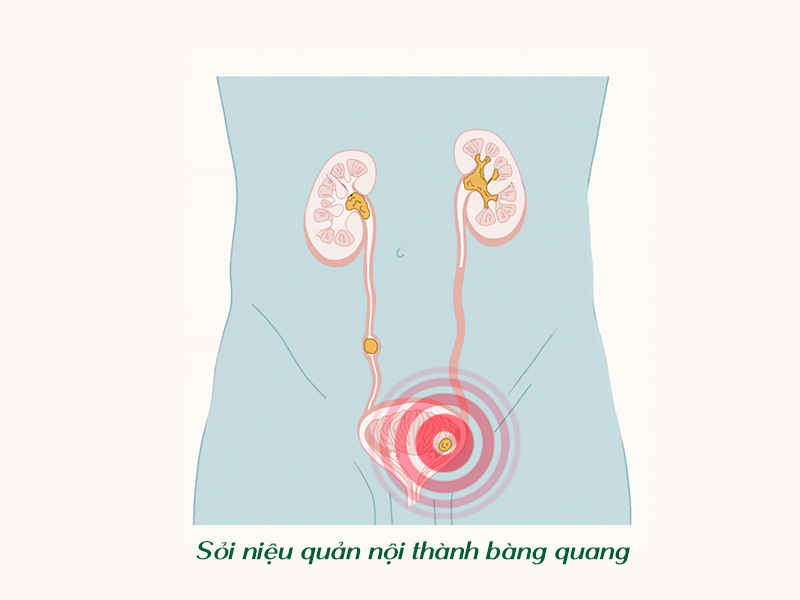 Sỏi niệu quản nội thành bàng quang