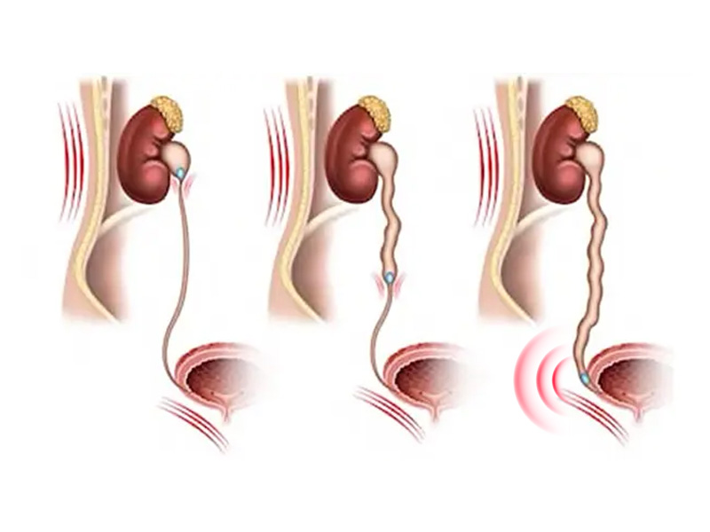 5 Biến chứng nguy hiểm của sỏi niệu quản ⅓ đoạn dưới