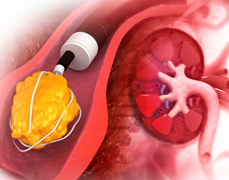 Sỏi thận có nên tán hay không?