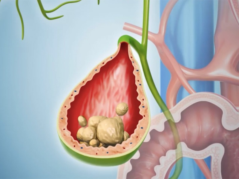 Sỏi túi mật có nhiều hình dạng và kích thước khác nhau 