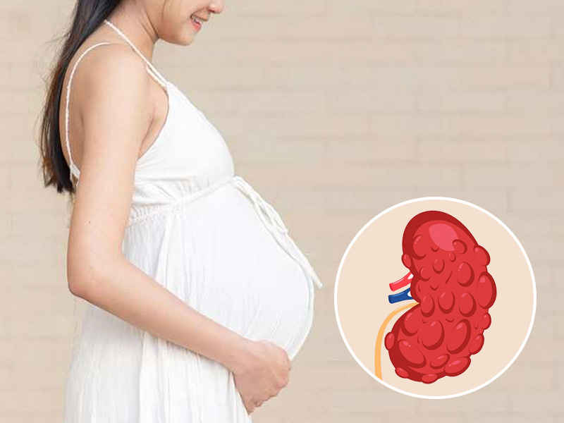 Thận đa nang thai nhi là kết quả bất thường khi phôi thai phát triển