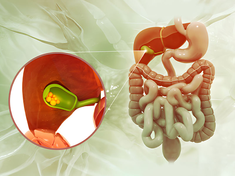 Trị sỏi mật bao lâu hết?